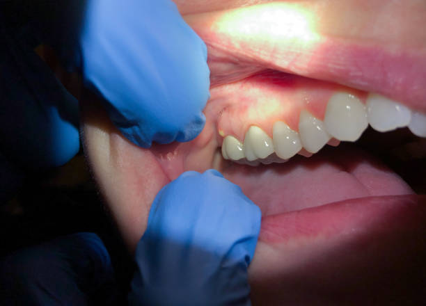 Best Emergency Dentist for Lost Fillings or Crowns in Forest View, IL